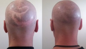 Tatouage contre la calvitie : pigmentation du cuir chevelu | TATTOO ...